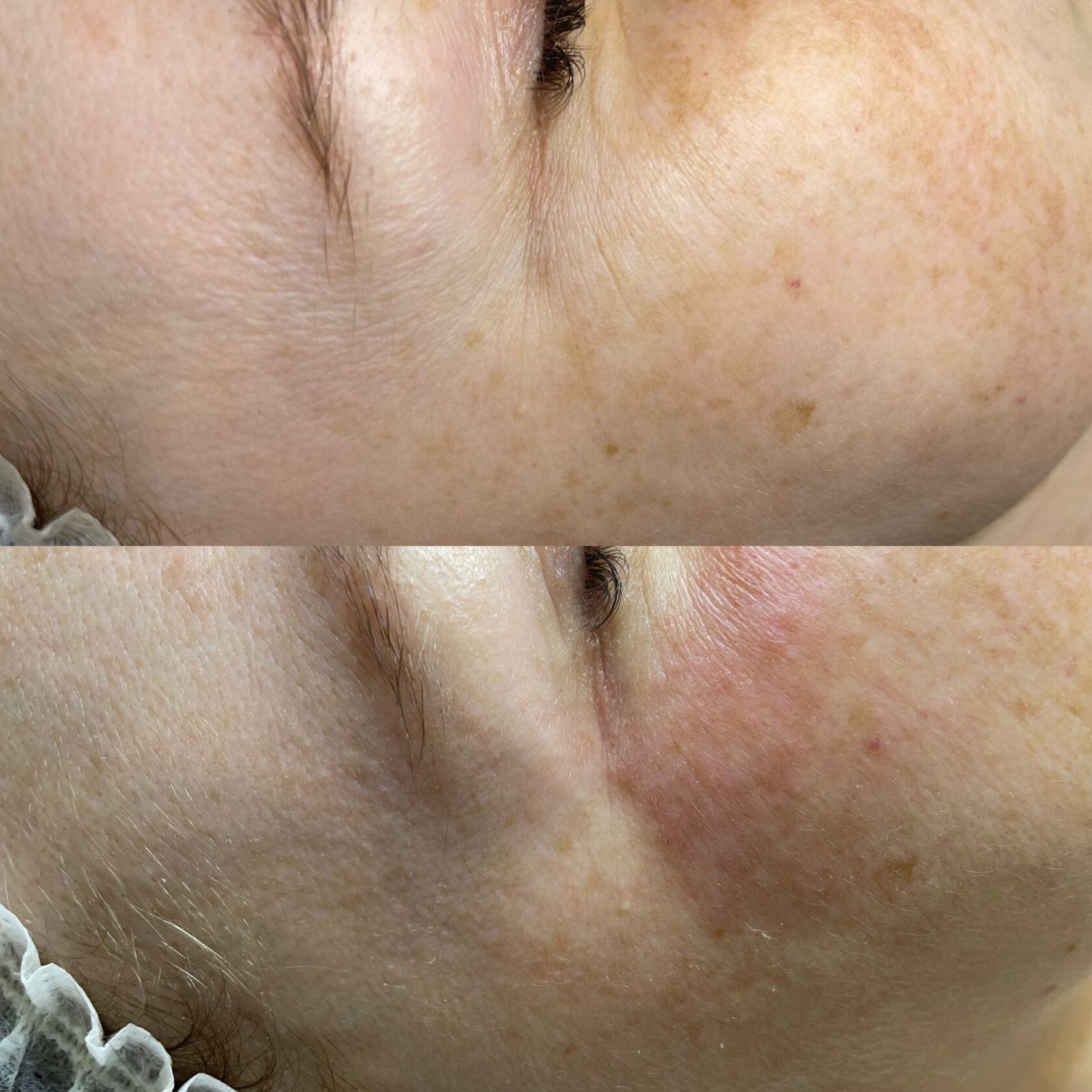 Sinapsi PRO VICI CLINIC Depilacja Laserowa LightSheer I HIFU I