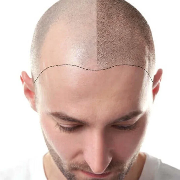 pigmentacja skóry głowy