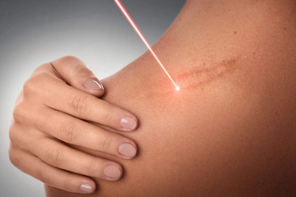 Zdjęcie wyróżnione zabiegu Laser Ablacyjny – Blizny chirurgiczne, pooparzeniowe i pourazowe